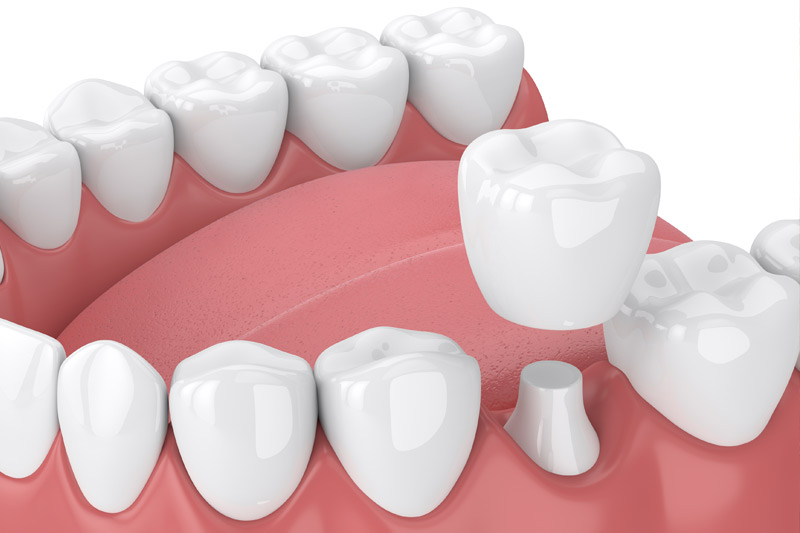 Dental Crowns in Apex