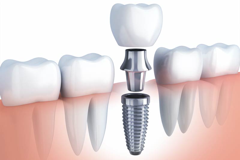 Implants Dentist in Apex